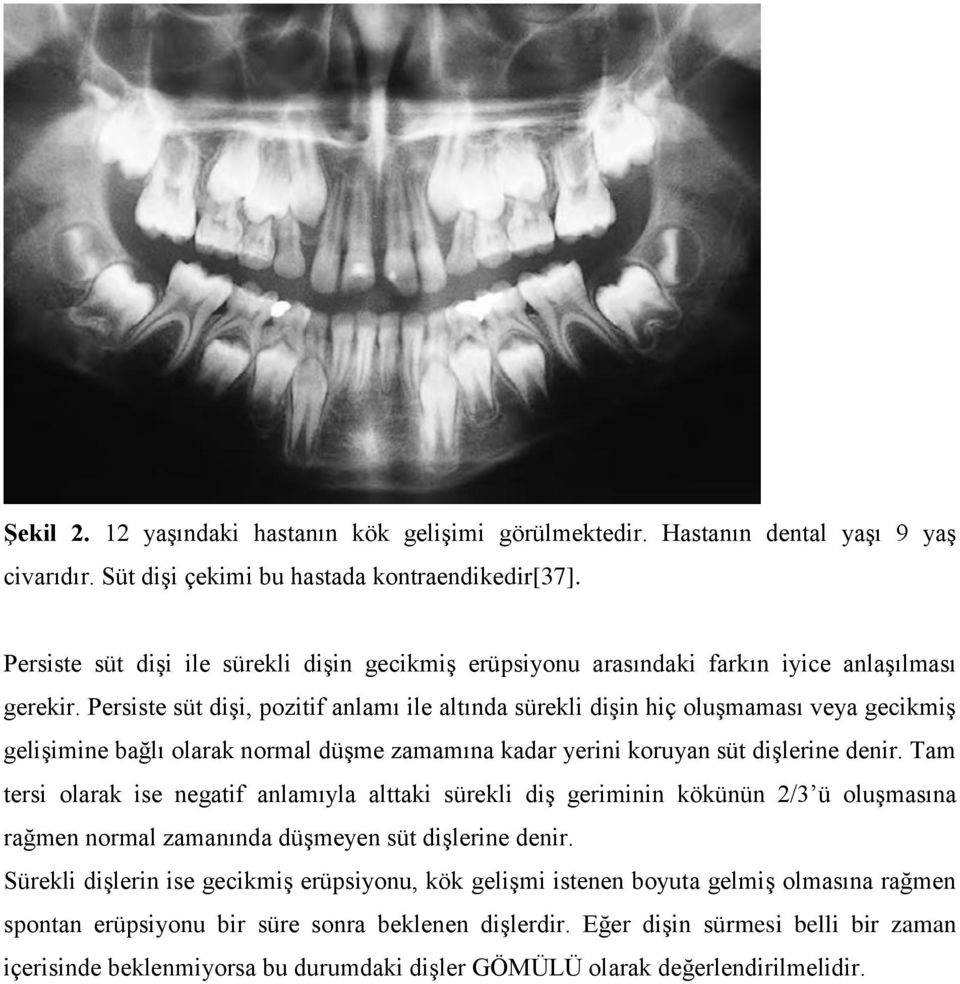 Persiste süt dişi, pozitif anlamı ile altında sürekli dişin hiç oluşmaması veya gecikmiş gelişimine bağlı olarak normal düşme zamamına kadar yerini koruyan süt dişlerine denir.