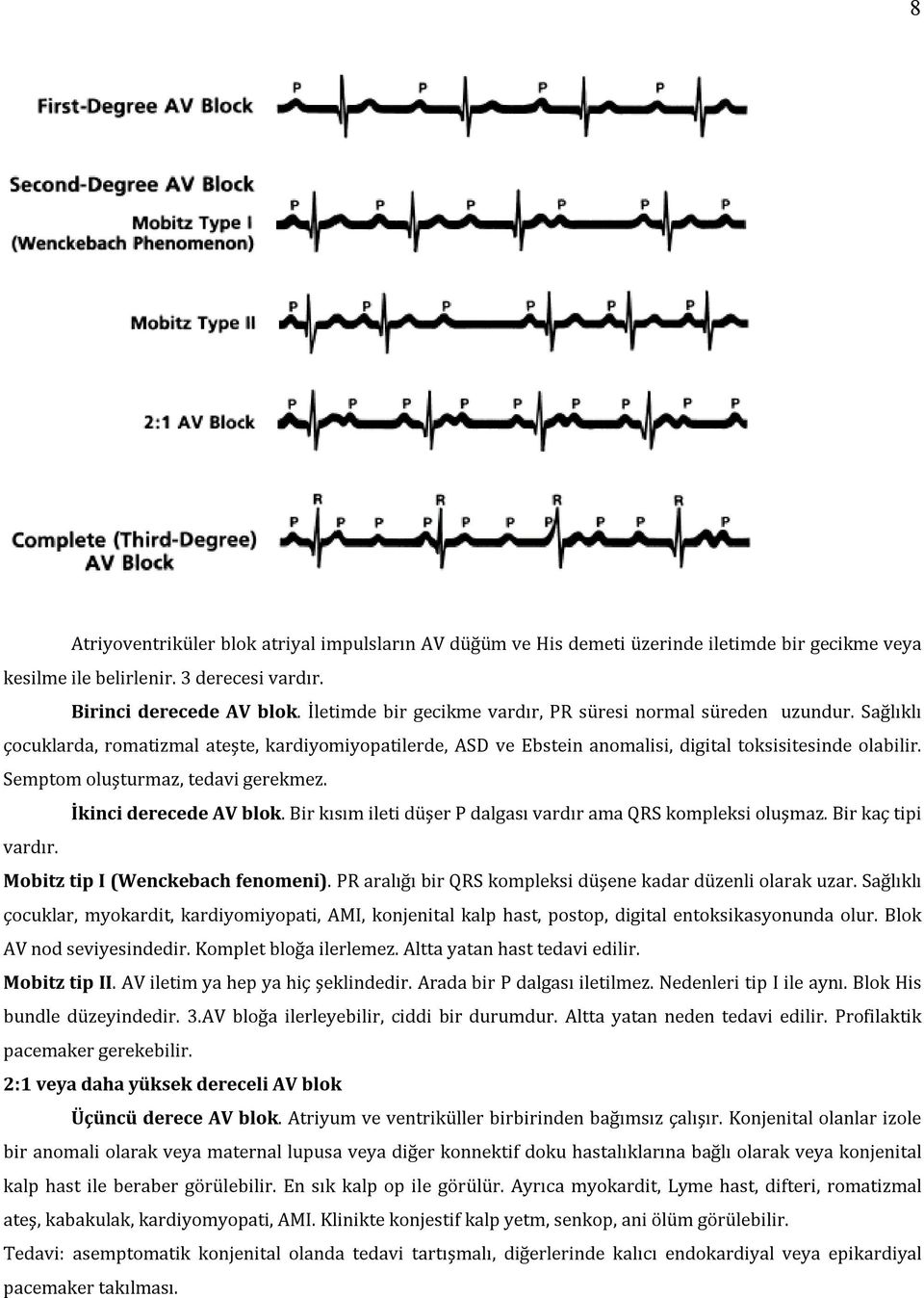 Semptom oluşturmaz, tedavi gerekmez. İkinci derecede AV blok. Bir kısım ileti düşer P dalgası vardır ama QRS kompleksi oluşmaz. Bir kaç tipi vardır. Mobitz tip I (Wenckebach fenomeni).