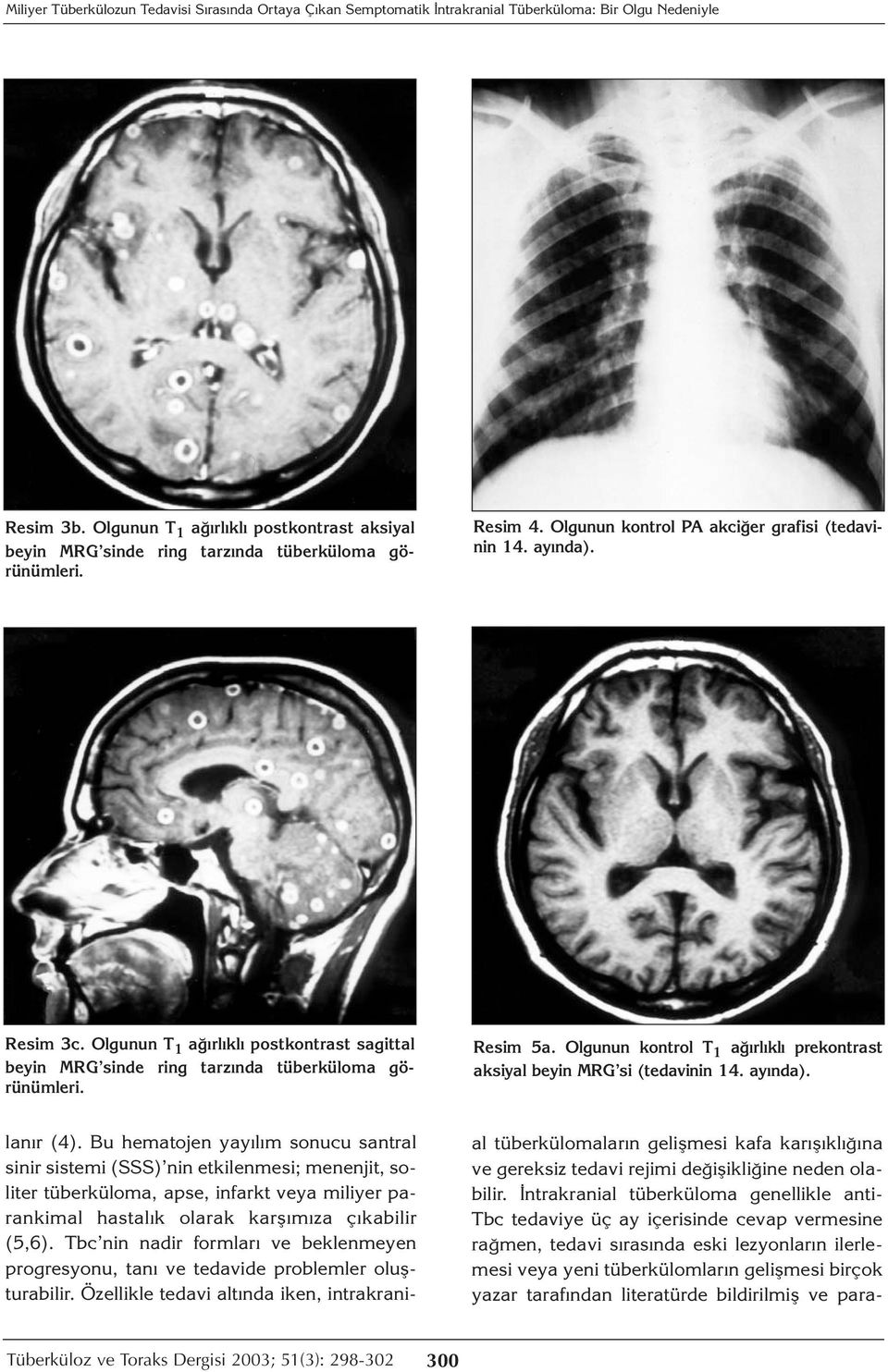 Olgunun T 1 ağırlıklı postkontrast sagittal beyin MRG sinde ring tarzında tüberküloma görünümleri. Resim 5a. Olgunun kontrol T 1 ağırlıklı prekontrast aksiyal beyin MRG si (tedavinin 14. ayında).