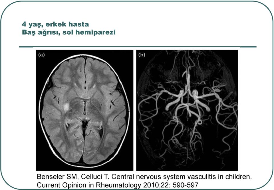 Central nervous system vasculitis in