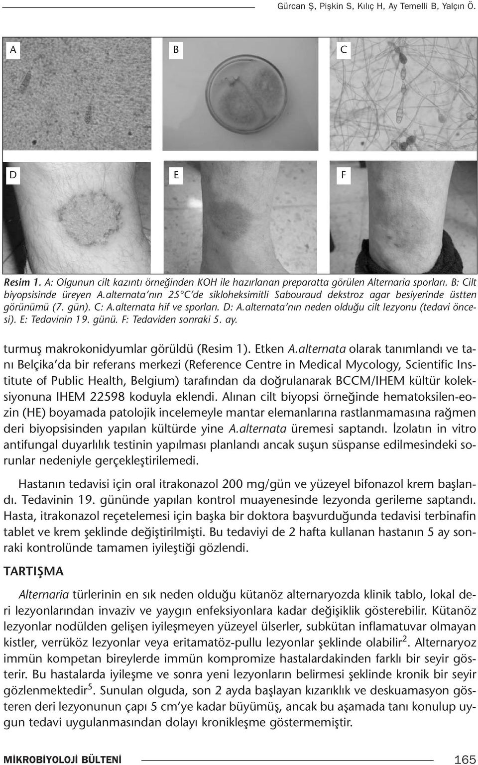 E: Tedavinin 19. günü. F: Tedaviden sonraki 5. ay. turmuş makrokonidyumlar görüldü (Resim 1). Etken A.