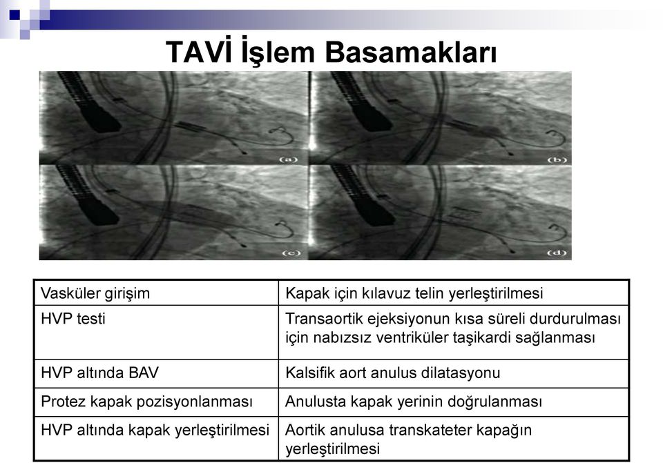 HVP altında BAV Protez kapak pozisyonlanması Kalsifik aort anulus dilatasyonu Anulusta kapak