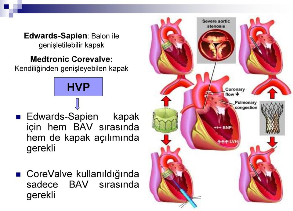 Edwards-Sapien kapak için hem BAV sırasında hem de kapak