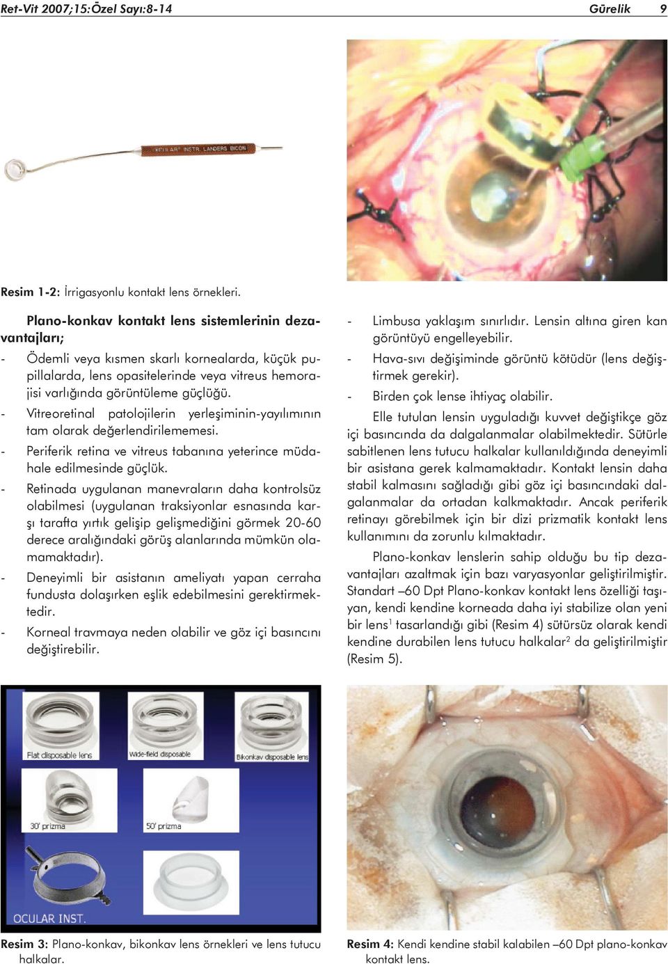 - Vitreoretinal patolojilerin yerleşiminin-yayılımının tam olarak değerlendirilememesi. - Periferik retina ve vitreus tabanına yeterince müdahale edilmesinde güçlük.