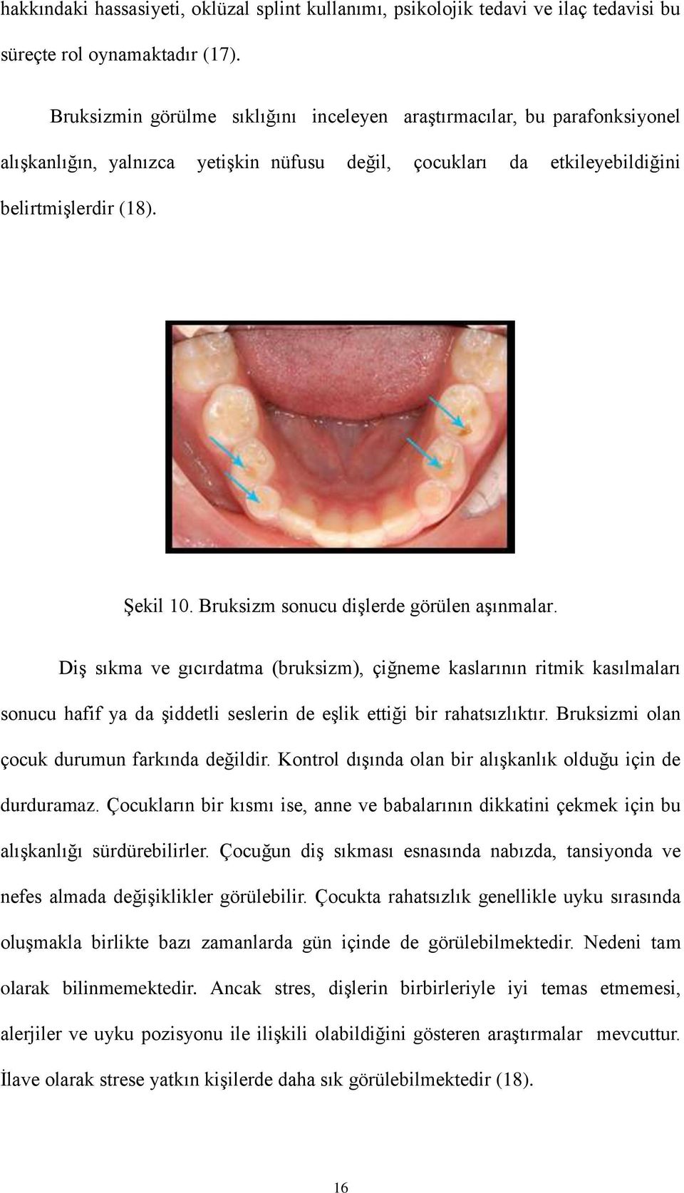 Bruksizm sonucu dişlerde görülen aşınmalar. Diş sıkma ve gıcırdatma (bruksizm), çiğneme kaslarının ritmik kasılmaları sonucu hafif ya da şiddetli seslerin de eşlik ettiği bir rahatsızlıktır.