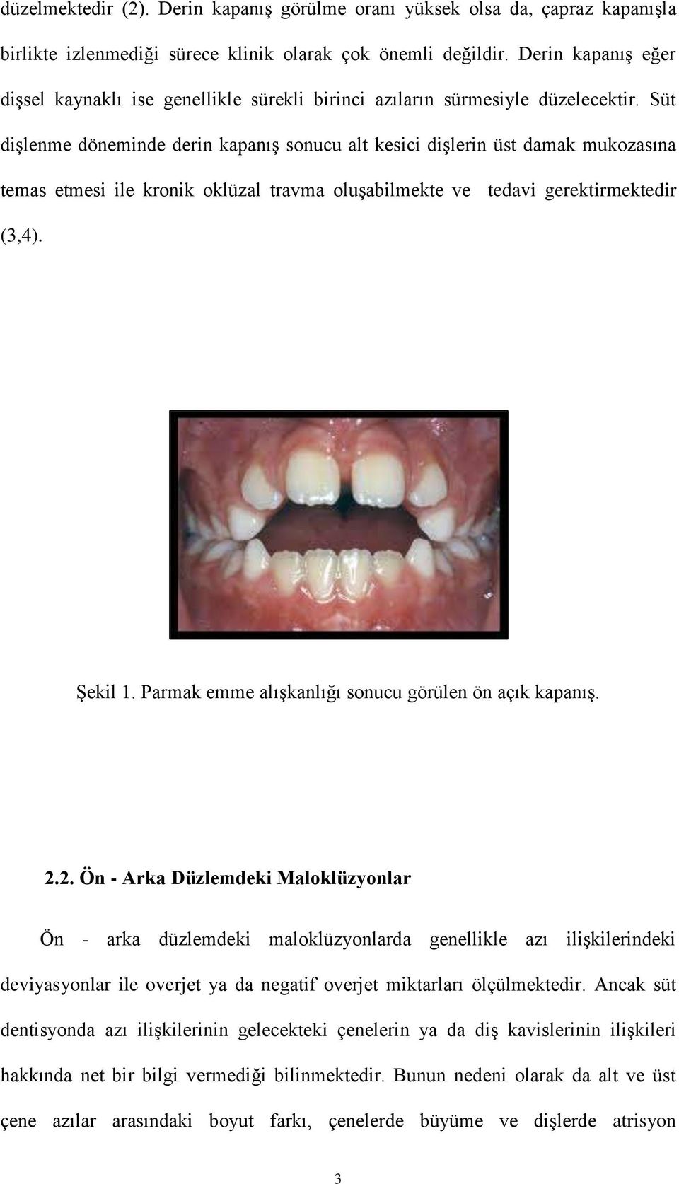 Süt dişlenme döneminde derin kapanış sonucu alt kesici dişlerin üst damak mukozasına temas etmesi ile kronik oklüzal travma oluşabilmekte ve tedavi gerektirmektedir (3,4). Şekil 1.