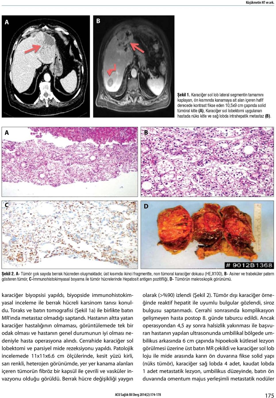 uygulanan hastada nüks kitle ve sağ lobda intrahepatik metastaz (B). A B C D Şekil 2.