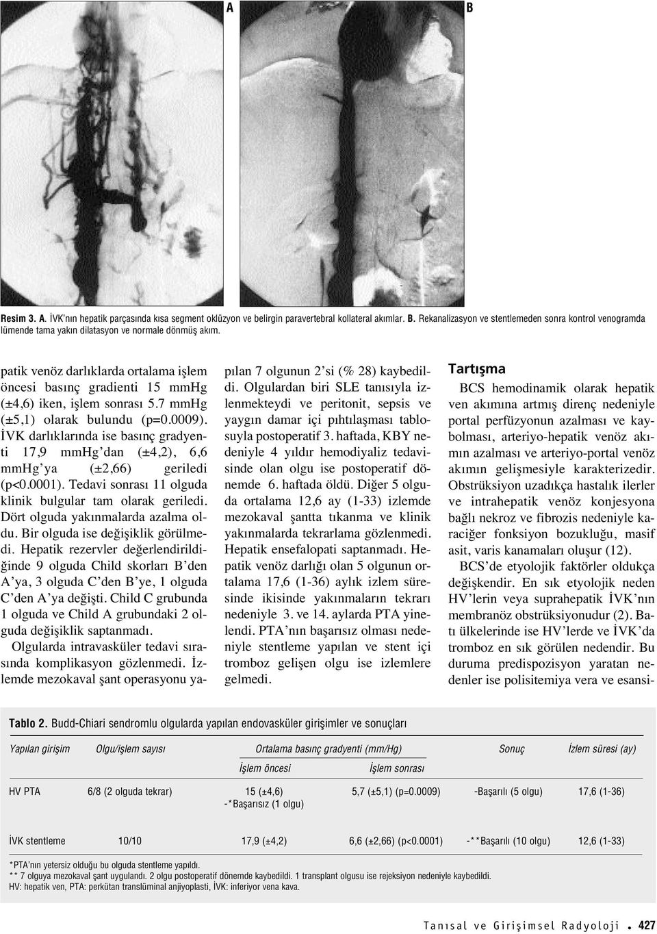 İVK darl klar nda ise bas nç gradyenti 17,9 mmhg dan (±4,2), 6,6 mmhg ya (±2,66) geriledi (p<0.0001). Tedavi sonras 11 olguda klinik bulgular tam olarak geriledi. Dört olguda yak nmalarda azalma oldu.