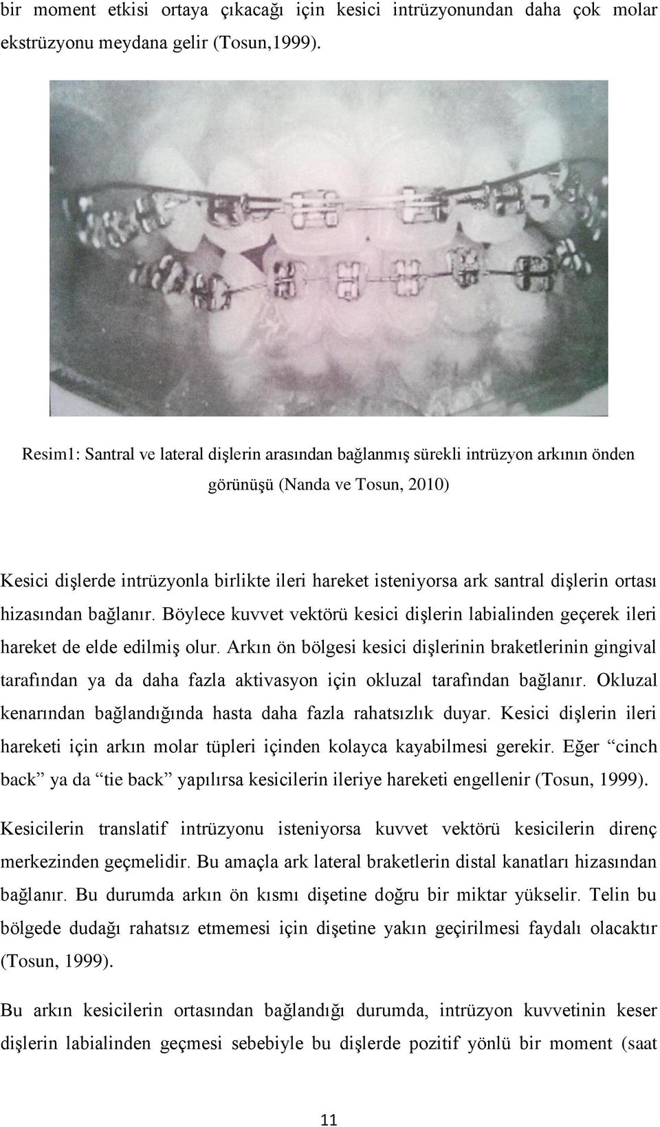 diģlerin ortası hizasından bağlanır. Böylece kuvvet vektörü kesici diģlerin labialinden geçerek ileri hareket de elde edilmiģ olur.