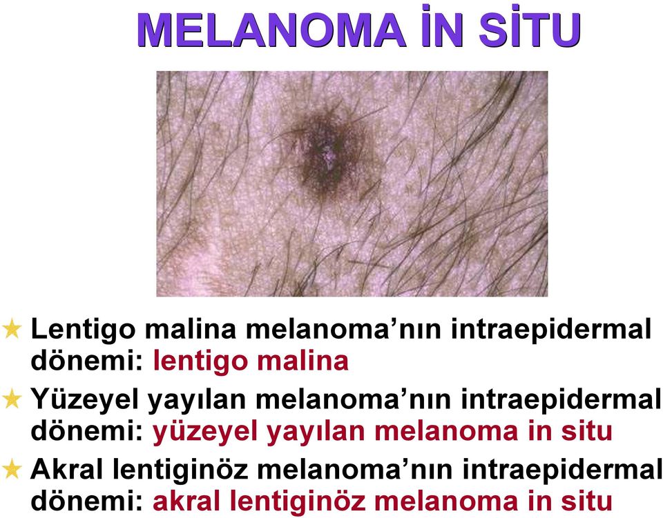 intraepidermal dönemi: yüzeyel yayılan melanoma in situ Akral