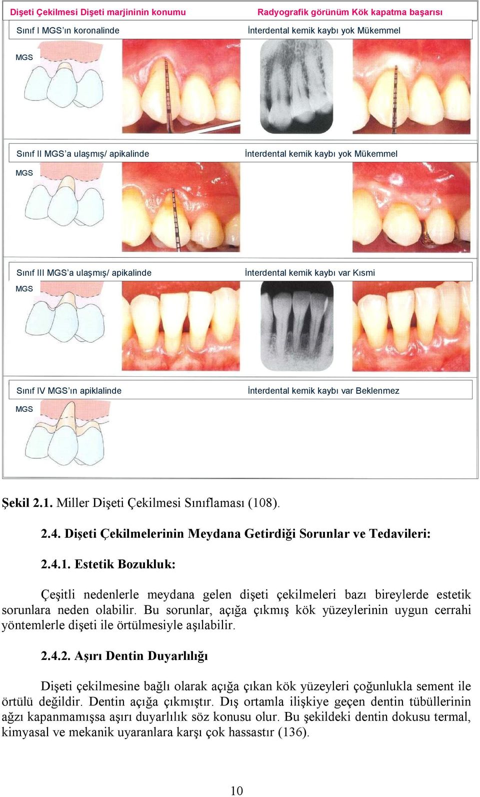 Miller Dişeti Çekilmesi Sınıflaması (108). 2.4. Dişeti Çekilmelerinin Meydana Getirdiği Sorunlar ve Tedavileri: 2.4.1. Estetik Bozukluk: Çeşitli nedenlerle meydana gelen dişeti çekilmeleri bazı bireylerde estetik sorunlara neden olabilir.