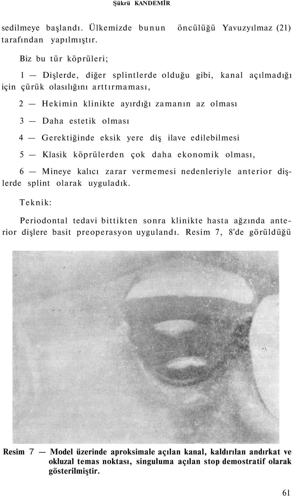 Gerektiğinde eksik yere diş ilave edilebilmesi 5 Klasik köprülerden çok daha ekonomik olması, 6 Mineye kalıcı zarar vermemesi nedenleriyle anterior dişlerde splint olarak uyguladık.