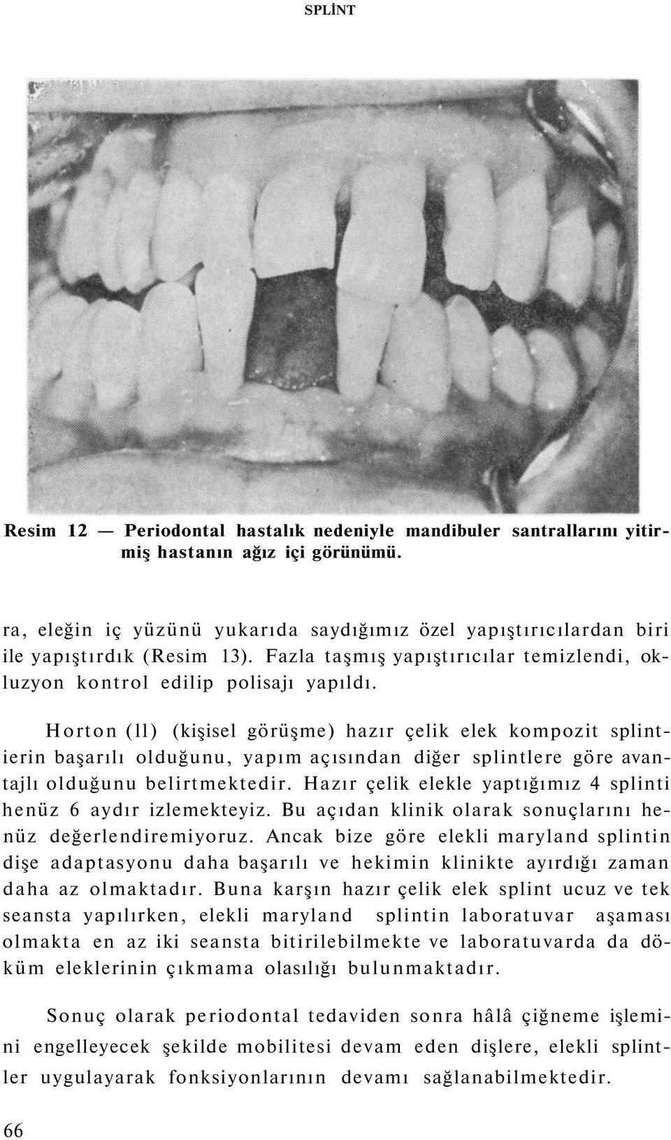 Horton (ll) (kişisel görüşme) hazır çelik elek kompozit splintierin başarılı olduğunu, yapım açısından diğer splintlere göre avantajlı olduğunu belirtmektedir.