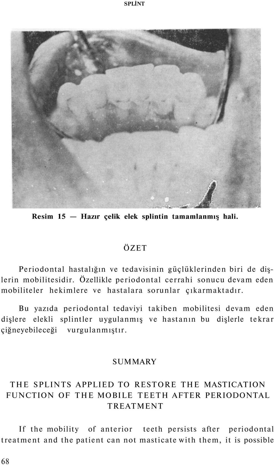 Bu yazıda periodontal tedaviyi takiben mobilitesi devam eden dişlere elekli splintler uygulanmış ve hastanın bu dişlerle tekrar çiğneyebileceği vurgulanmıştır.