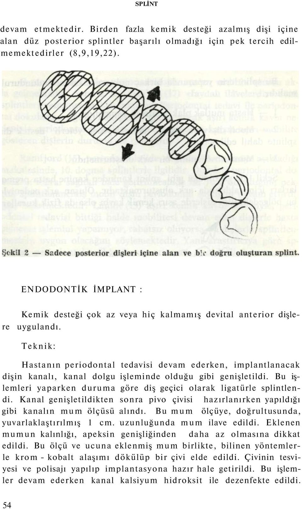 Teknik: Hastanın periodontal tedavisi devam ederken, implantlanacak dişin kanalı, kanal dolgu işleminde olduğu gibi genişletildi.