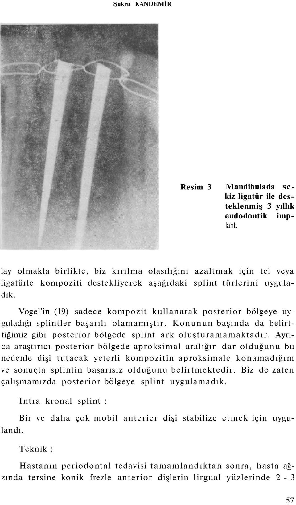 Vogel'in (19) sadece kompozit kullanarak posterior bölgeye uyguladığı splintler başarılı olamamıştır. Konunun başında da belirttiğimiz gibi posterior bölgede splint ark oluşturamamaktadır.