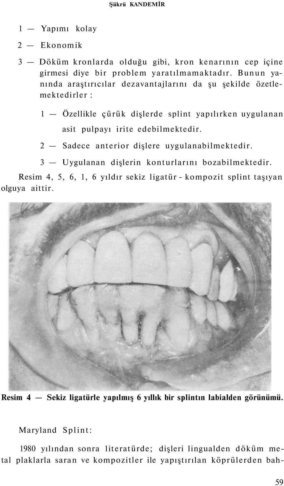 2 Sadece anterior dişlere uygulanabilmektedir. 3 Uygulanan dişlerin konturlarını bozabilmektedir. Resim 4, 5, 6, 1, 6 yıldır sekiz ligatür - kompozit splint taşıyan olguya aittir.