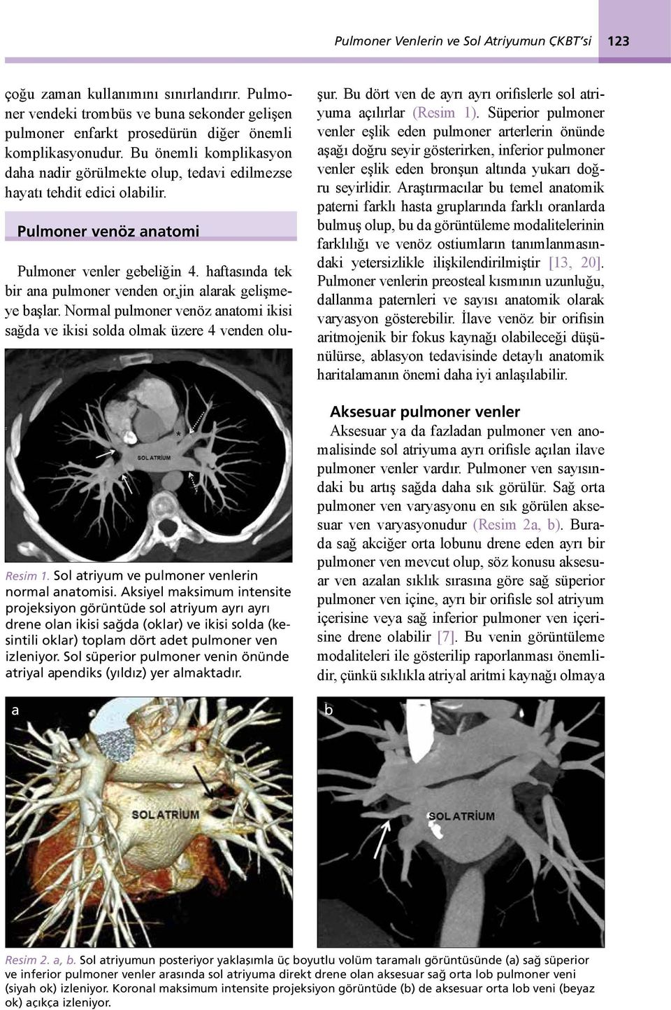 Aksiyel maksimum intensite projeksiyon görüntüde sol atriyum ayrı ayrı drene olan ikisi sağda (oklar) ve ikisi solda (kesintili oklar) toplam dört adet pulmoner ven izleniyor.