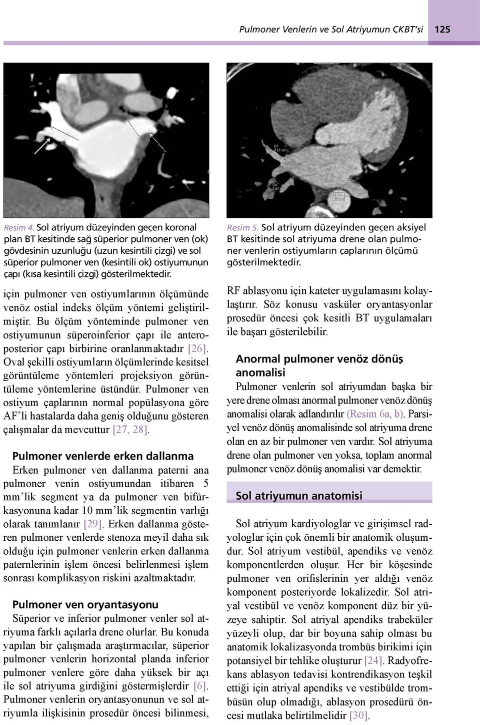 kesintili çizgi) gösterilmektedir. için pulmoner ven ostiyumlarının ölçümünde venöz ostial indeks ölçüm yöntemi geliştirilmiştir.