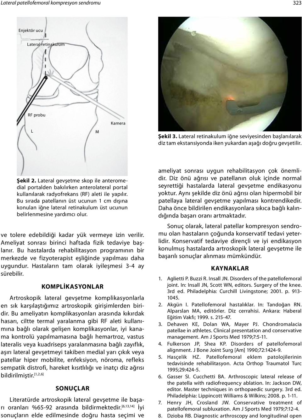 Lateral gevşetme skop ile anteromedial portalden bakılırken anterolateral portal kullanılarak radyofrekans (RF) aleti ile yapılır.