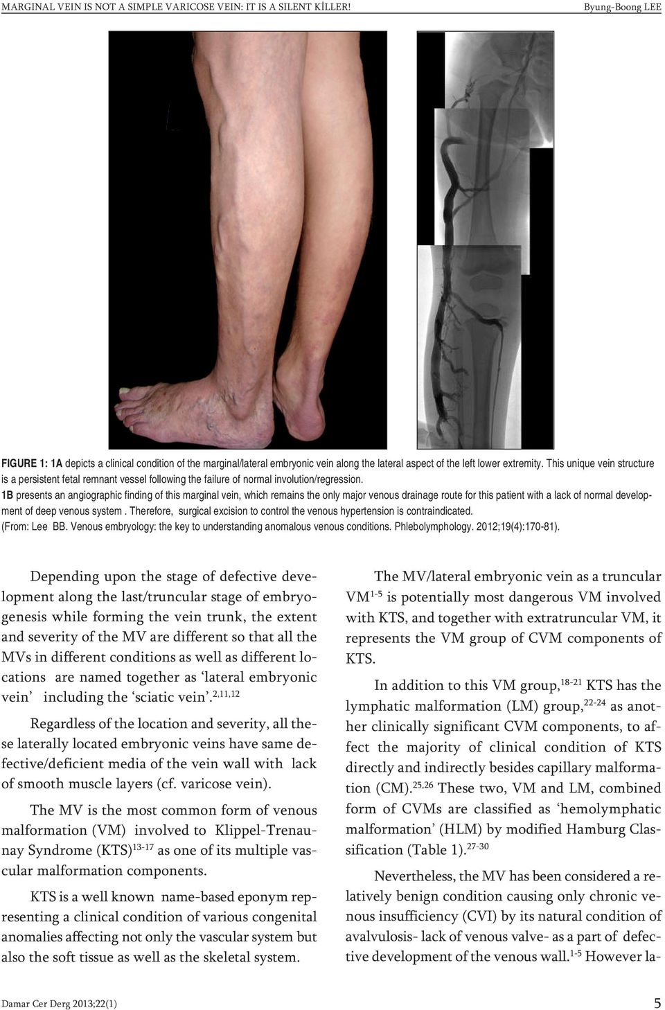 This unique vein structure is a persistent fetal remnant vessel following the failure of normal involution/regression.