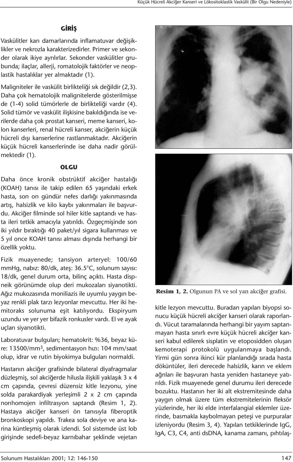 Maligniteler ile vaskülit birlikteliği sık değildir (2,3). Daha çok hematolojik malignitelerde gösterilmişse de (1-4) solid tümörlerle de birlikteliği vardır (4).