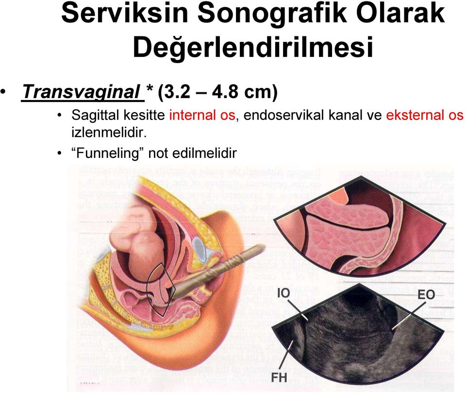 8 cm) Sagittal kesitte internal os,