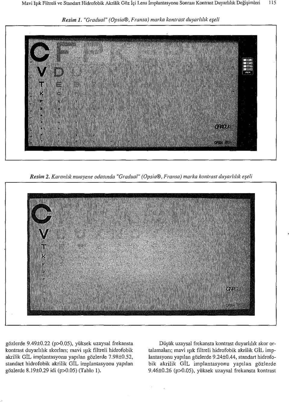 05), ytiksek uzaysal frekansta kontrast duyarhhk skorlan; mavi l lk filtreli hidrofobik akrilik GiL implantasyonu yap!lan gozlerde 7.98±0.52, standart hidrofobik akrilik GiL implantasyonu yap!