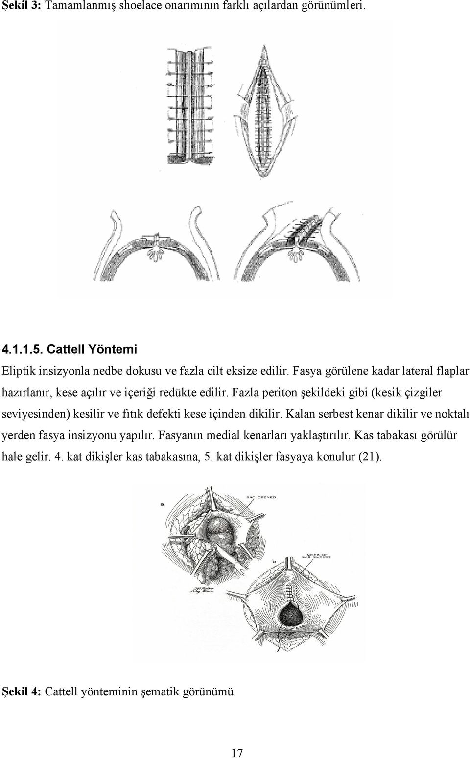 Fasya görülene kadar lateral flaplar hazırlanır, kese açılır ve içeriği redükte edilir.