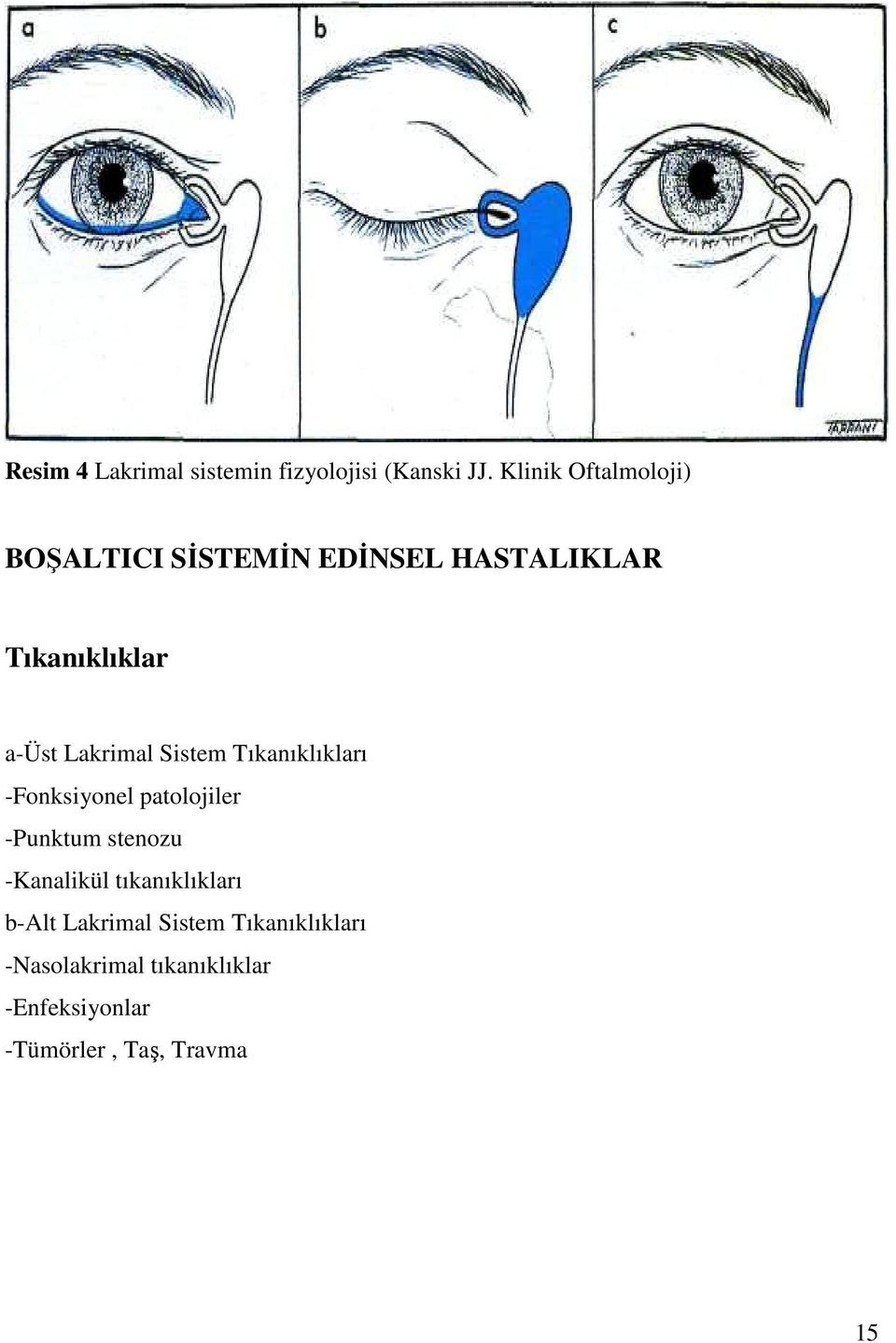 Lakrimal Sistem Tıkanıklıkları -Fonksiyonel patolojiler -Punktum stenozu -Kanalikül