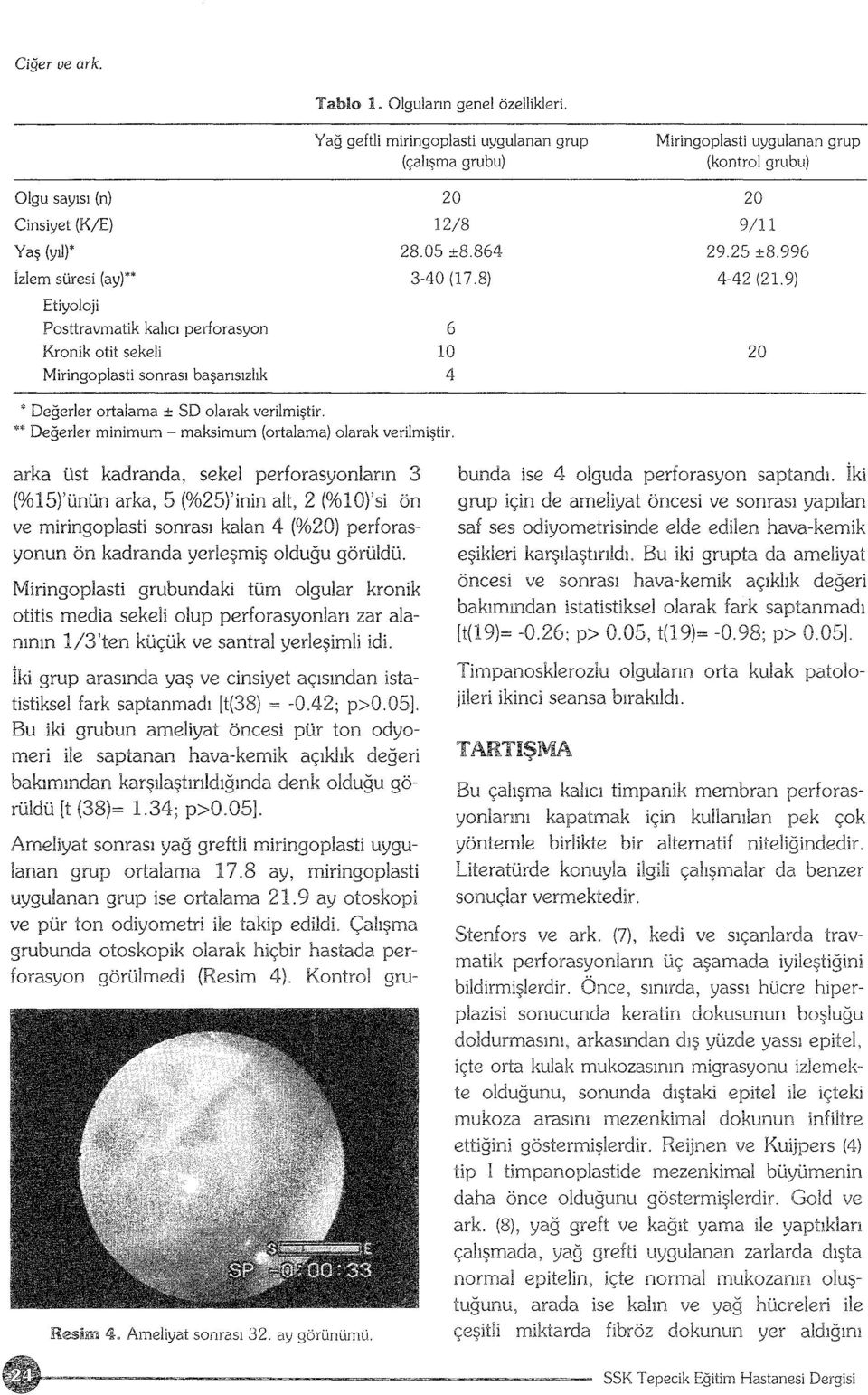 perforasyon Kronik otit sekeli Miringoplasti sonrası başarısızlık 20 20 12/8 28.05 ±8.864 3-40 (1 7 8) 6 lo 4 9/11 29.25 ±8.996 4-42 (21.9) 20 * Değerler ortalama ± SO olarak verilmiştir.