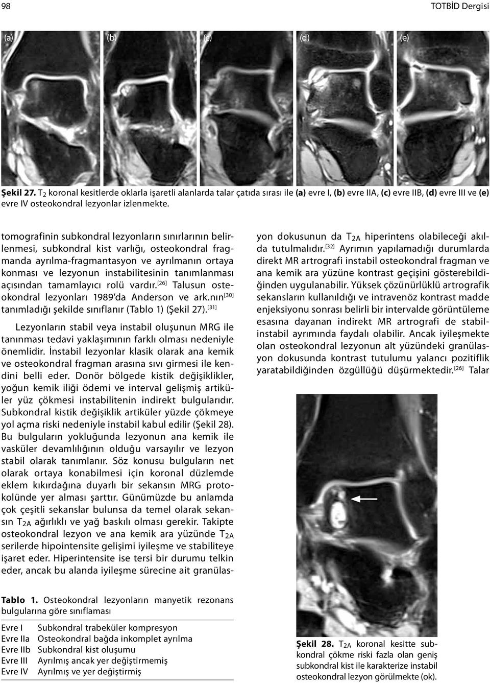 tomografinin subkondral lezyonların sınırlarının belirlenmesi, subkondral kist varlığı, osteokondral fragmanda ayrılma-fragmantasyon ve ayrılmanın ortaya konması ve lezyonun instabilitesinin