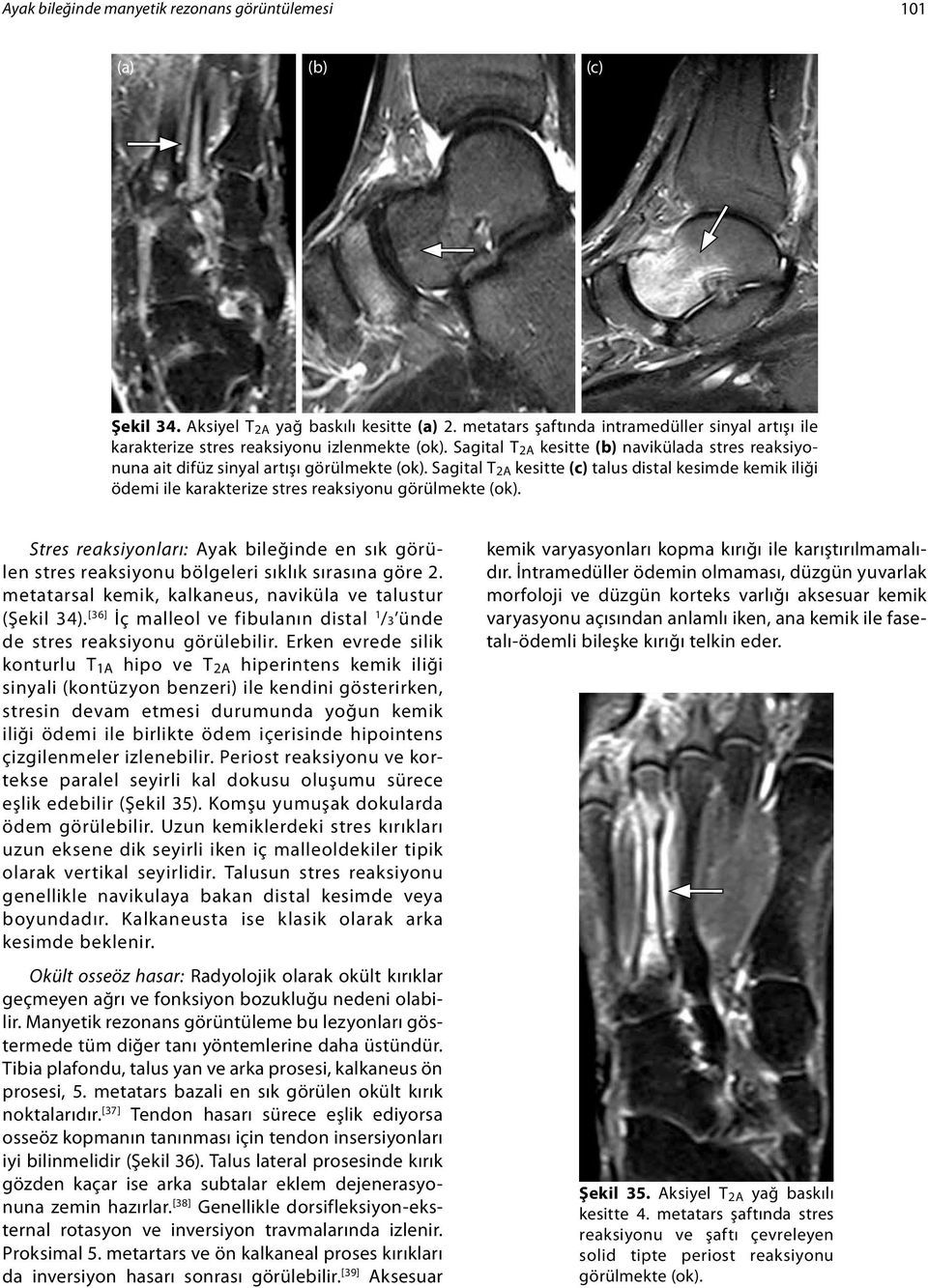 Sagital T 2A kesitte (c) talus distal kesimde kemik iliği ödemi ile karakterize stres reaksiyonu görülmekte (ok).