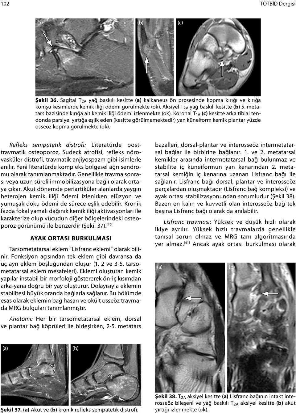 Koronal T 1A (c) kesitte arka tibial tendonda parsiyel yırtığa eşlik eden (kesitte görülmemektedir) yan küneiform kemik plantar yüzde osseöz kopma görülmekte (ok).