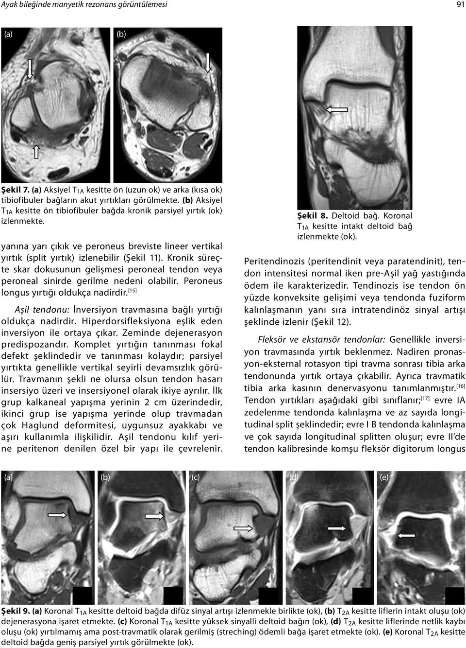 Kronik süreçte skar dokusunun gelişmesi peroneal tendon veya peroneal sinirde gerilme nedeni olabilir. Peroneus longus yırtığı oldukça nadirdir.