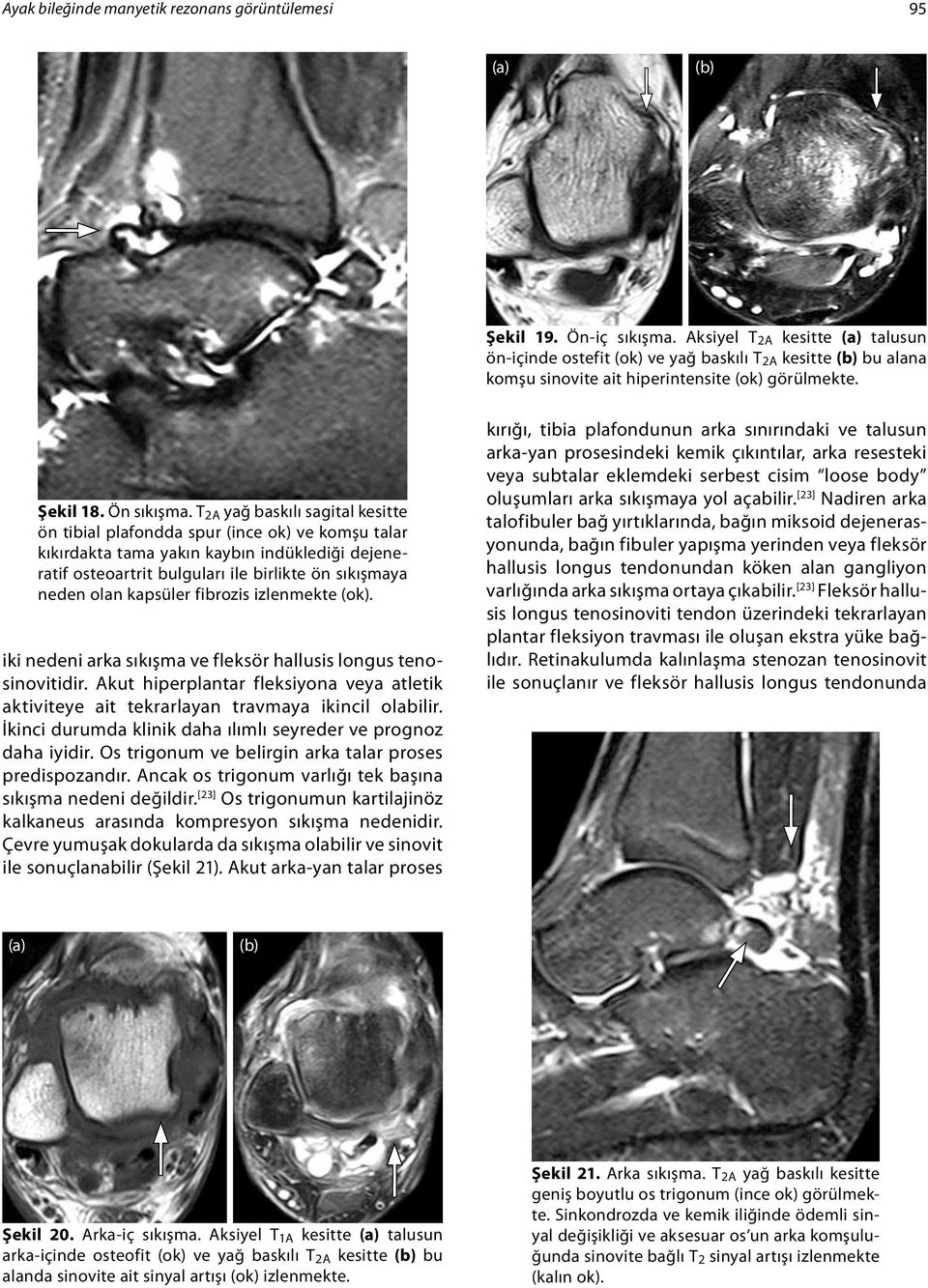 T 2A yağ baskılı sagital kesitte ön tibial plafondda spur (ince ok) ve komşu talar kıkırdakta tama yakın kaybın indüklediği dejeneratif osteoartrit bulguları ile birlikte ön sıkışmaya neden olan