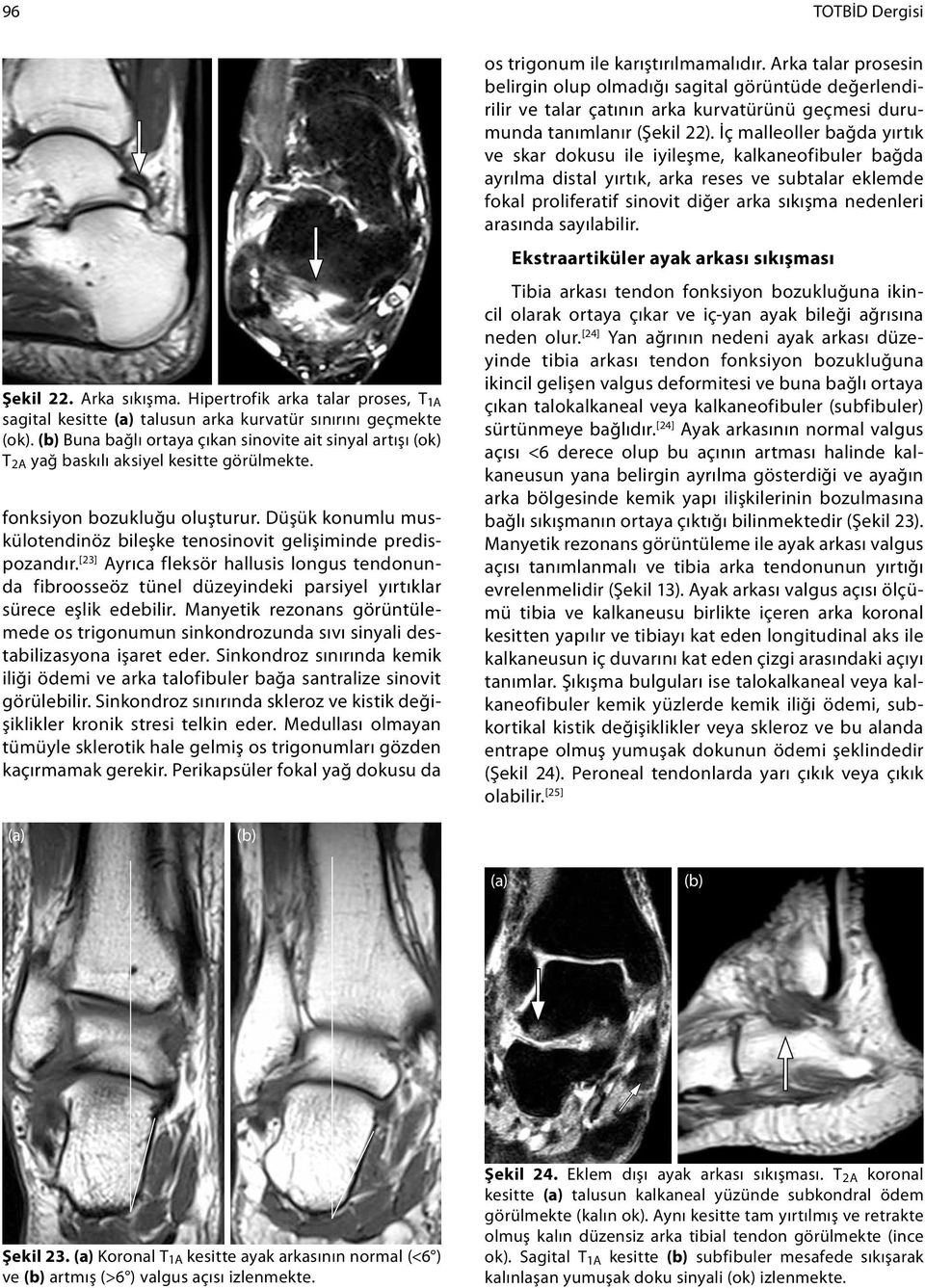 Düşük konumlu muskülotendinöz bileşke tenosinovit gelişiminde predispozandır. [23] Ayrıca fleksör hallusis longus tendonunda fibroosseöz tünel düzeyindeki parsiyel yırtıklar sürece eşlik edebilir.