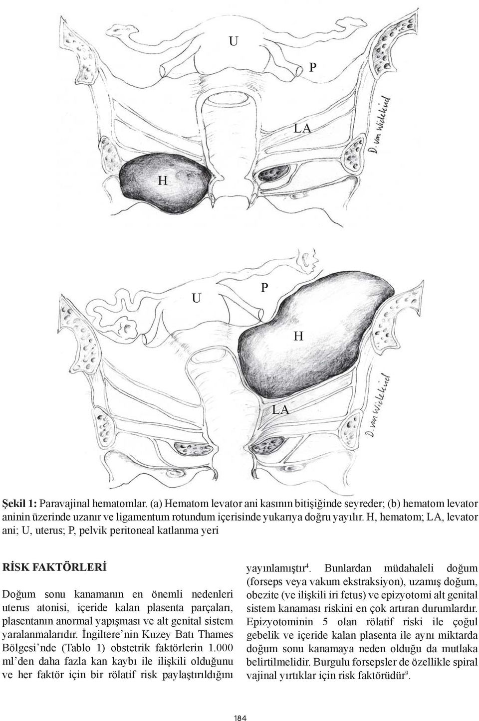 H, hematom; LA, levator ani; U, uterus; P, pelvik peritoneal katlanma yeri RİSK FAKTÖRLERİ Doğum sonu kanamanın en önemli nedenleri uterus atonisi, içeride kalan plasenta parçaları, plasentanın