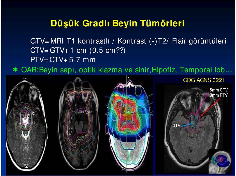 CTV=GTV+1 cm (0.5 cm?