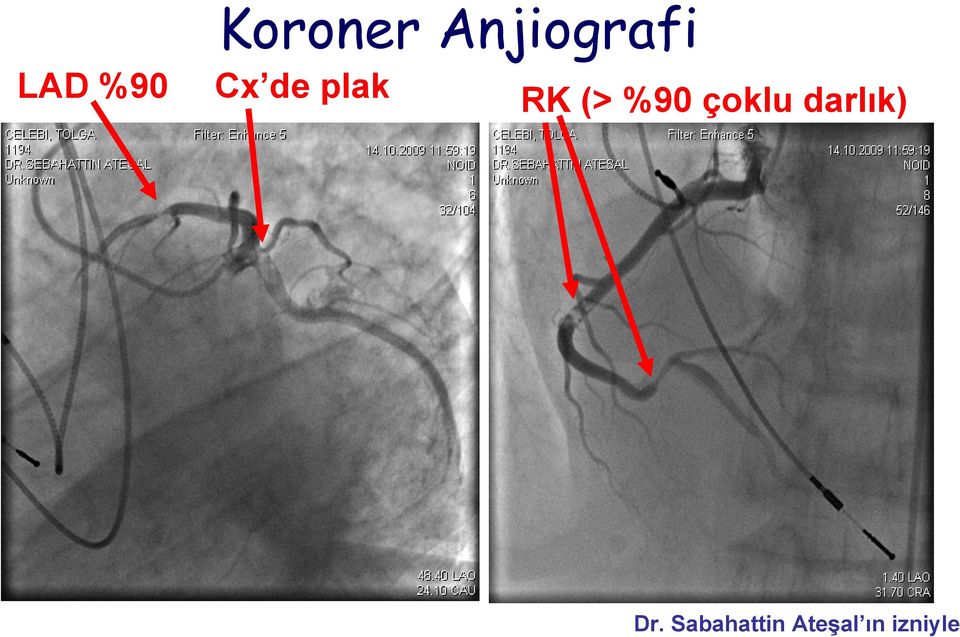 %90 çoklu darlık) Dr.