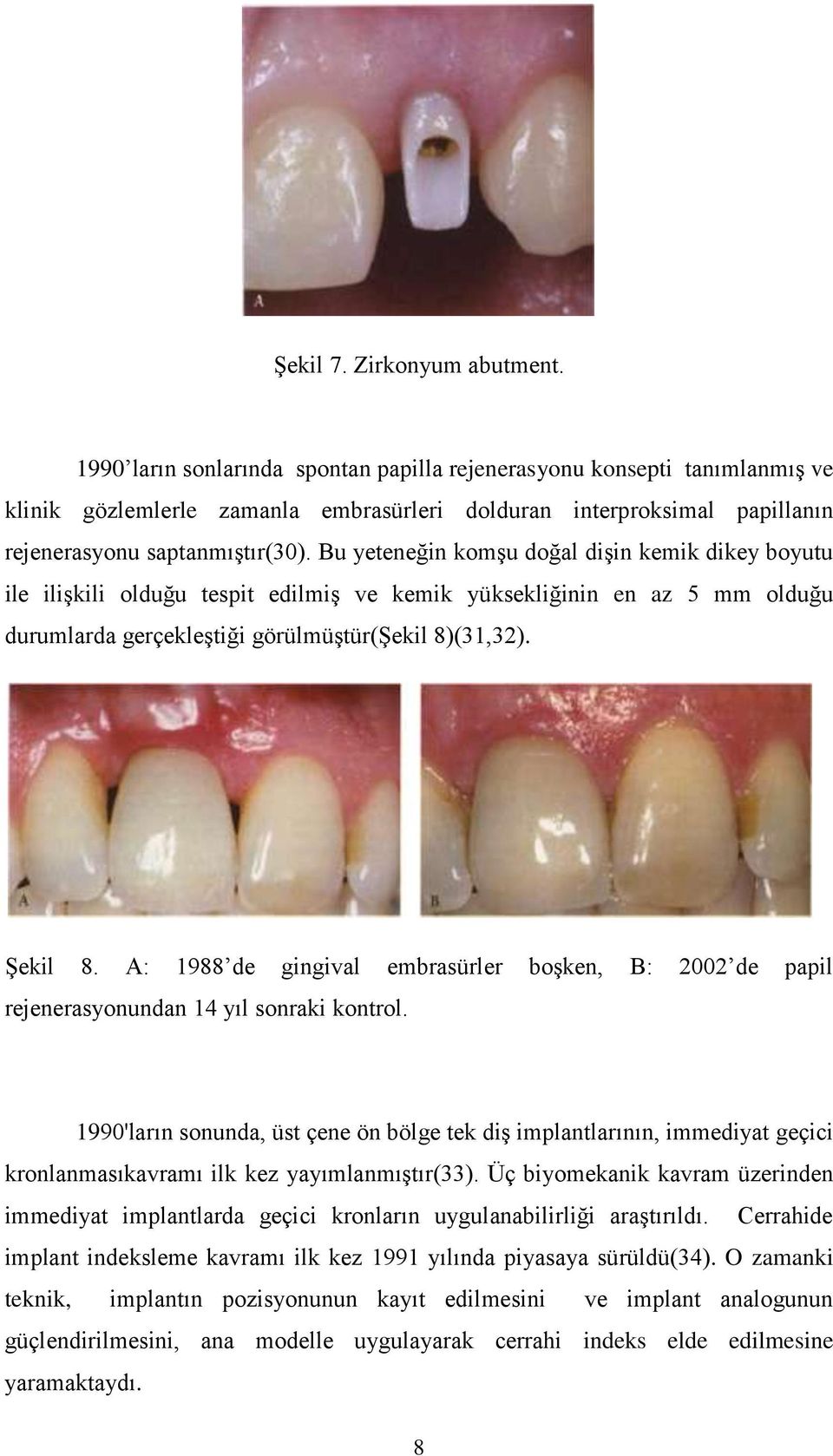 Bu yeteneğin komşu doğal dişin kemik dikey boyutu ile ilişkili olduğu tespit edilmiş ve kemik yüksekliğinin en az 5 mm olduğu durumlarda gerçekleştiği görülmüştür(şekil 8)(31,32). Şekil 8.