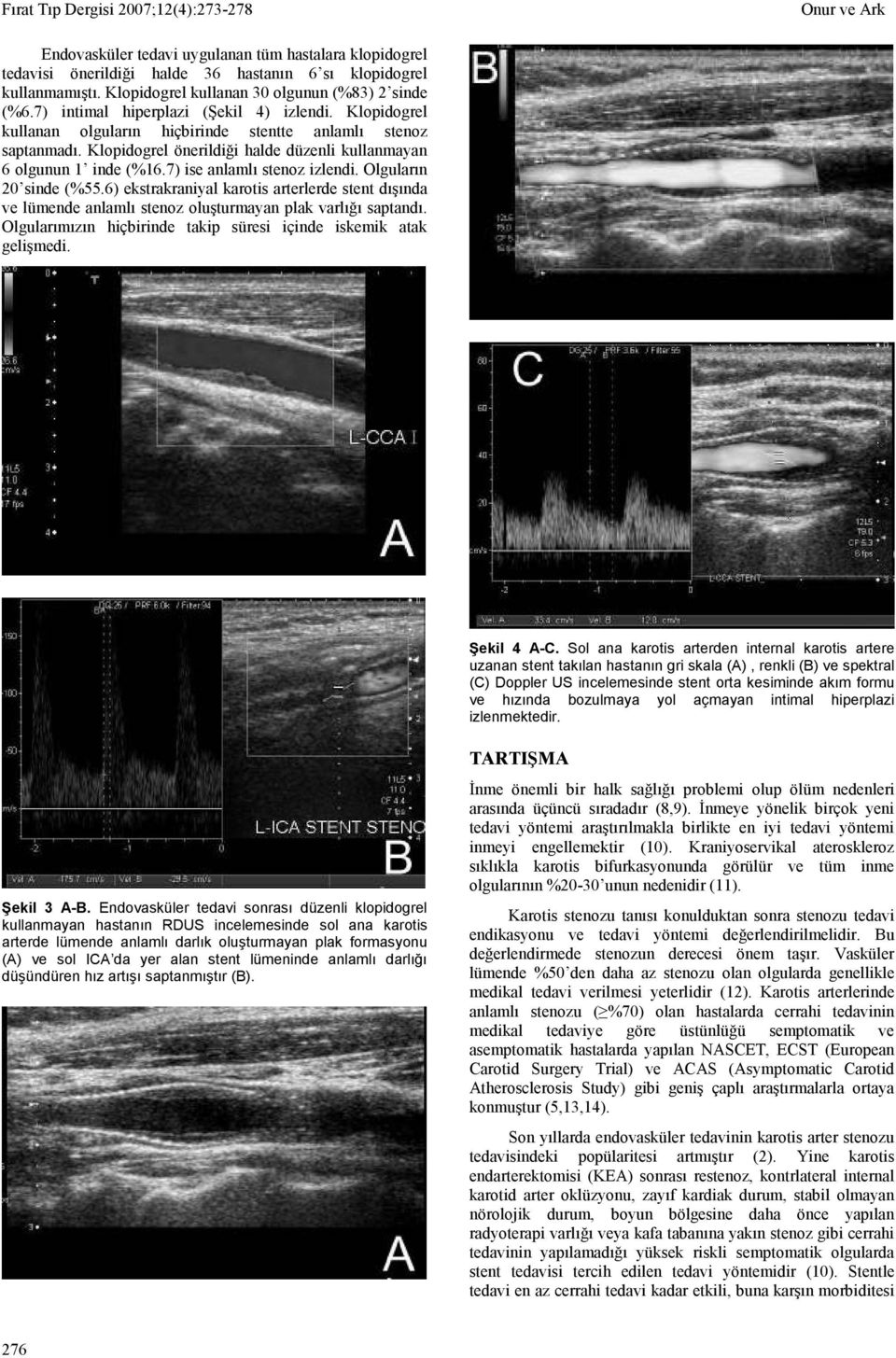 7) ise anlamlı stenoz izlendi. Olguların 20 sinde (%55.6) ekstrakraniyal karotis arterlerde stent dışında ve lümende anlamlı stenoz oluşturmayan plak varlığı saptandı.