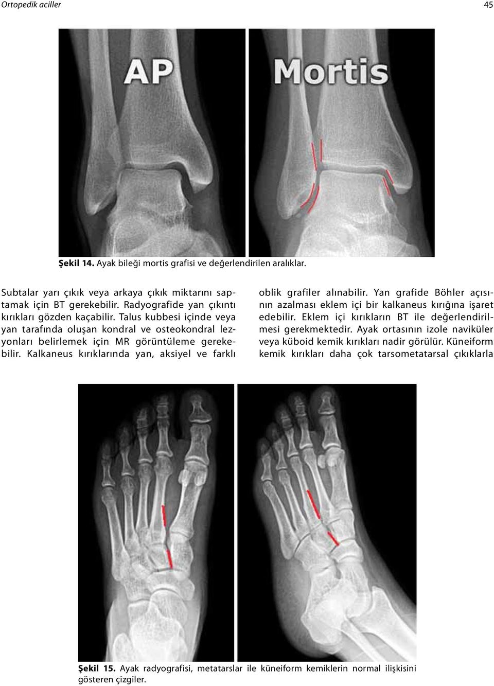 Kalkaneus kırıklarında yan, aksiyel ve farklı oblik grafiler alınabilir. Yan grafide Böhler açısının azalması eklem içi bir kalkaneus kırığına işaret edebilir.