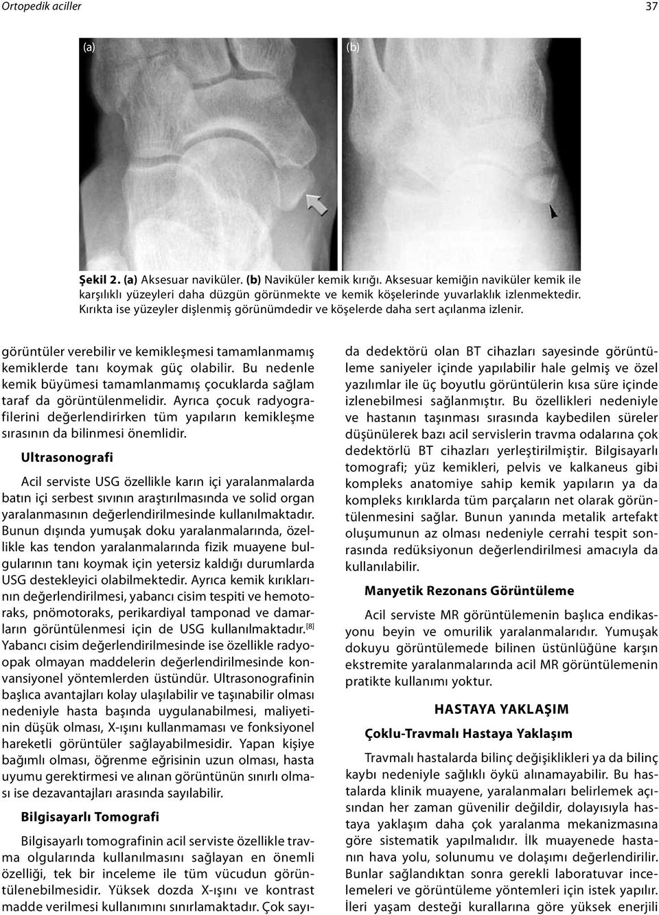 Kırıkta ise yüzeyler dişlenmiş görünümdedir ve köşelerde daha sert açılanma izlenir. görüntüler verebilir ve kemikleşmesi tamamlanmamış kemiklerde tanı koymak güç olabilir.