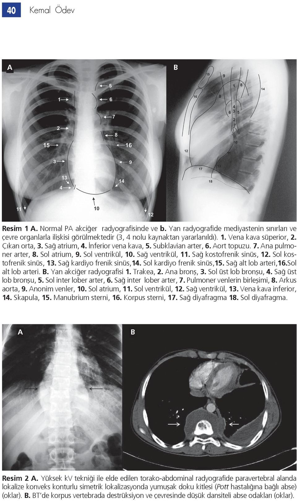 Sol kostofrenik sinüs, 13. Sağ kardiyo frenik sinüs,14. Sol kardiyo frenik sinüs,15. Sağ alt lob arteri,16.sol alt lob arteri.. Yan akciğer radyografisi 1. Trakea, 2. na bronş, 3.