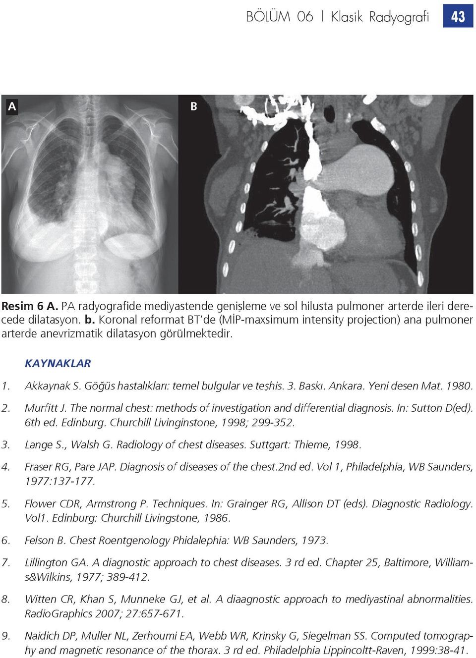 Yeni desen Mat. 1980. 2. Murfitt J. The normal chest: methods of investigation and differential diagnosis. In: Sutton D(ed). 6th ed. Edinburg. Churchill Livinginstone, 1998; 299-352. 3. Lange S.