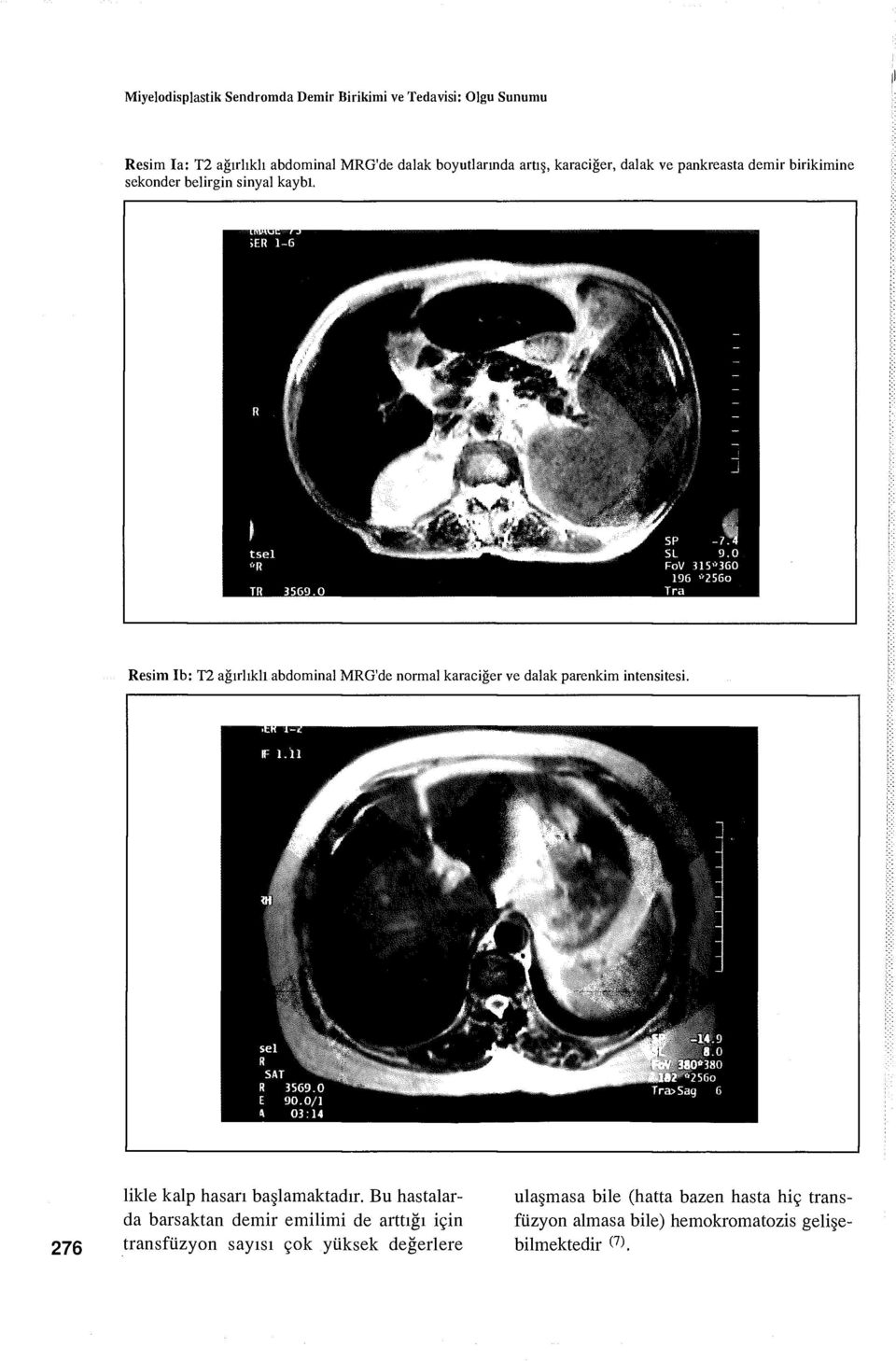 Resim Ib: T2 ağırlıklı abdominal MRG'de normal karaciğer ve dalak parenkim intensitesi. 276 likle kalp hasarı başlamaktadır.