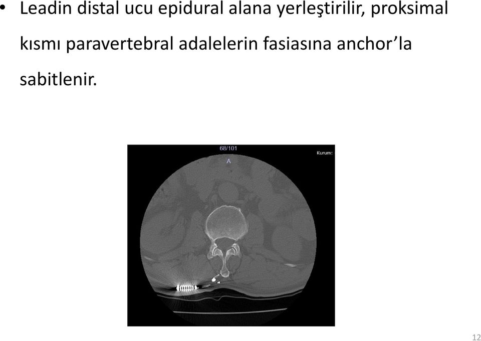 kısmı paravertebral adalelerin