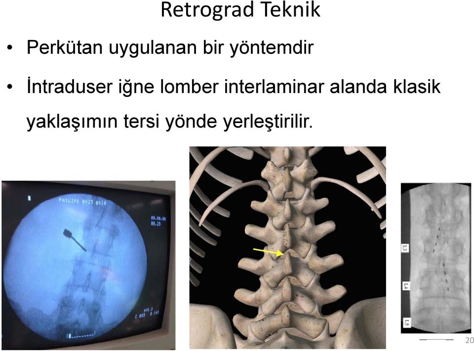 iğne lomber interlaminar alanda