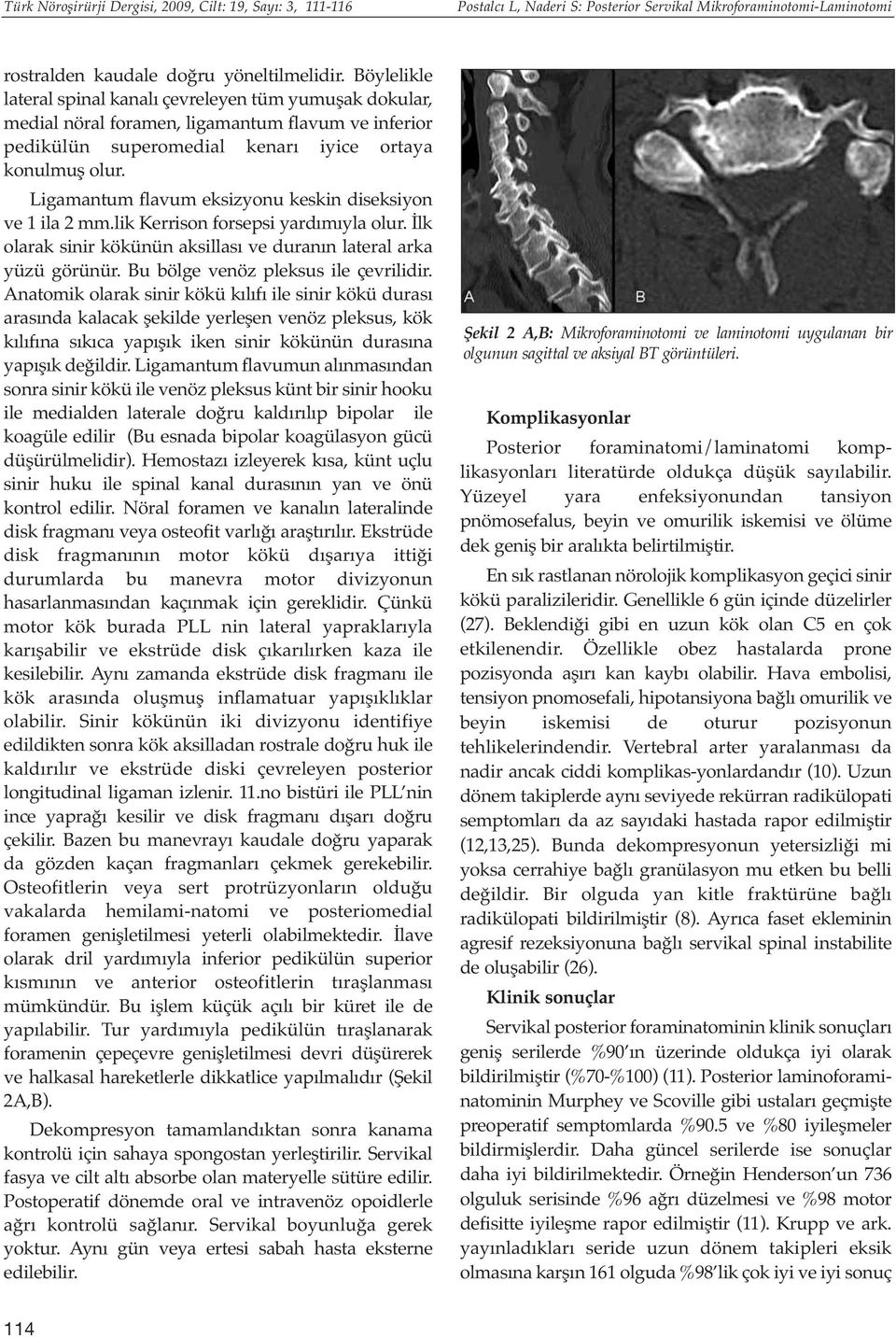 Ligamantum flavum eksizyonu keskin diseksiyon ve 1 ila 2 mm.lik Kerrison forsepsi yardımıyla olur. İlk olarak sinir kökünün aksillası ve duranın lateral arka yüzü görünür.